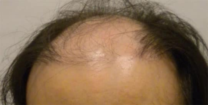 Correction of Previous Bad Hair Transplant - Correction of Bad Hair 