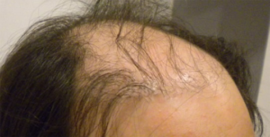 Correction of Previous Bad Hair Transplant - Correction of Bad Hair 