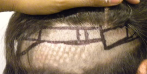 Correction of Previous Bad Hair Transplant - Correction of Bad Hair 
