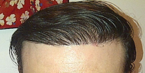 Correction of Previous Bad Hair Transplant - Correction of Bad Hair 