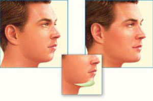 Facial Implant Treatment