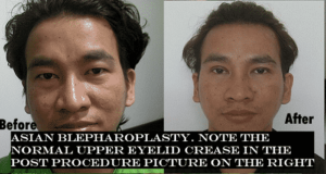 Asian Blepharoplasty Surgery Cost In Delhi , Gurgaon (India) : Eyelid Surgeon