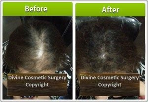 What Are Hair Fibers? - Hair Fibers Side Effects