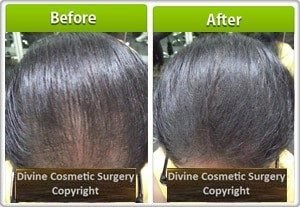 What Are Hair Fibers? - Hair Fibers Side Effects