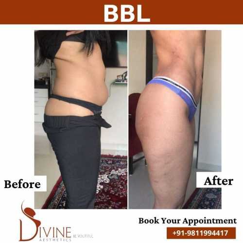 BBL-Before-after-jan-1