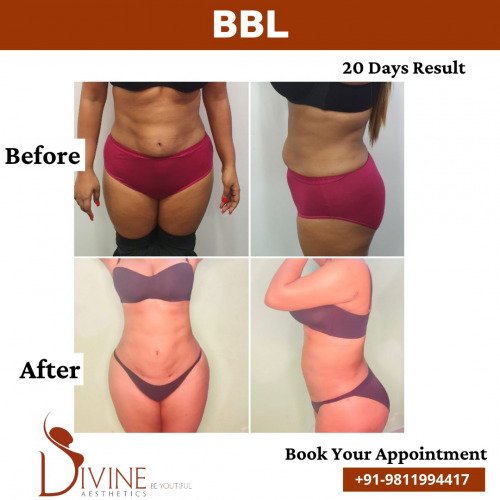 BBL-Surgery-before-after-1-March-2022