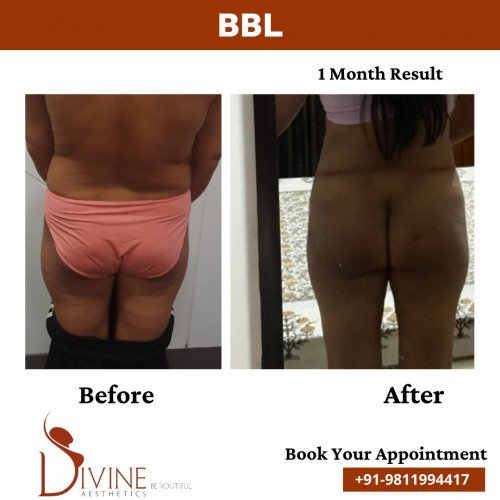BBL-Surgery-before-after-2-March-2022