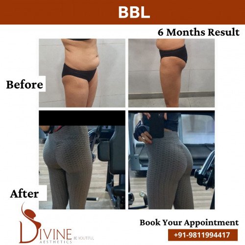 Brazilian-Buttock-Lift-Before-After-in-2022