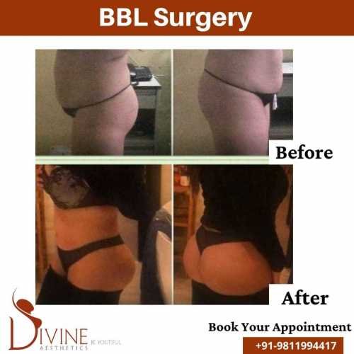 Brazillian-Buttock-Lift-Before-After-by-Divine-Cosmetic-Surgery