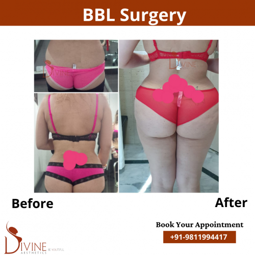 Brazillian Buttock Lift Before After