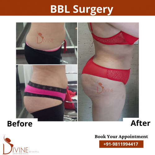 Brazillian Buttock Lift Surgery by dr Amit Gupta