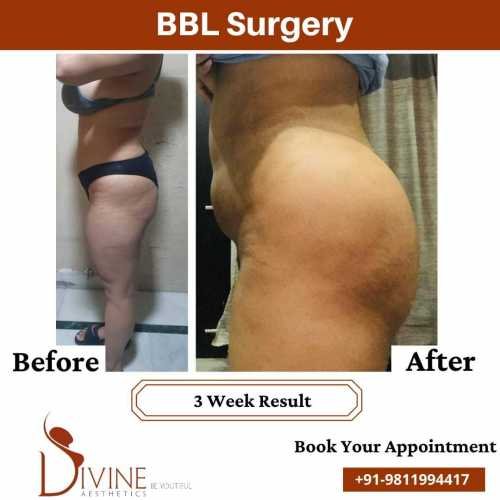 Brazillian-Buttock-Lift-Surgery-results-by-dr-Amit-Gupta