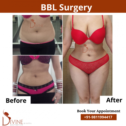 BBL with Vaser 4D Body Contouring