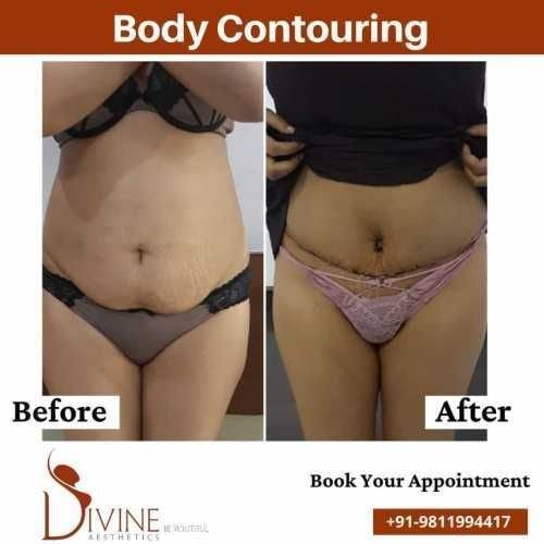 1_Body-Contouring-before-after.jpeg-nggid03515-ngg0dyn-500x500x100-00f0w010c010r110f110r010t010