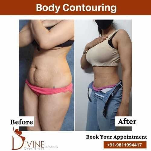 Body-Contouring-10.jpeg-nggid03516-ngg0dyn-500x500x100-00f0w010c010r110f110r010t010