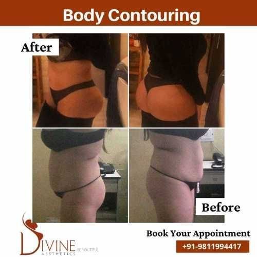 Body-Contouring-11.jpeg-nggid03519-ngg0dyn-500x500x100-00f0w010c010r110f110r010t010