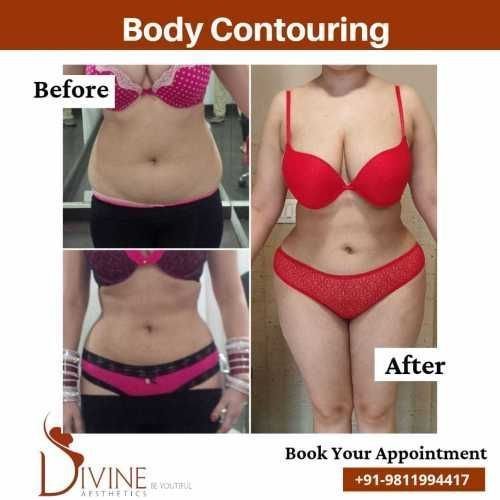 Body-Contouring-12.jpeg-nggid03520-ngg0dyn-500x500x100-00f0w010c010r110f110r010t010
