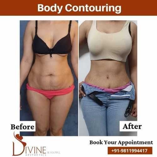 Body-Contouring-13.jpeg-nggid03518-ngg0dyn-500x500x100-00f0w010c010r110f110r010t010