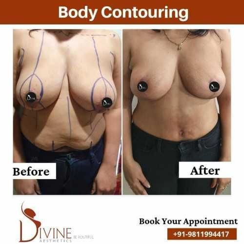 Body-Contouring-8.jpeg-nggid03517-ngg0dyn-500x500x100-00f0w010c010r110f110r010t010