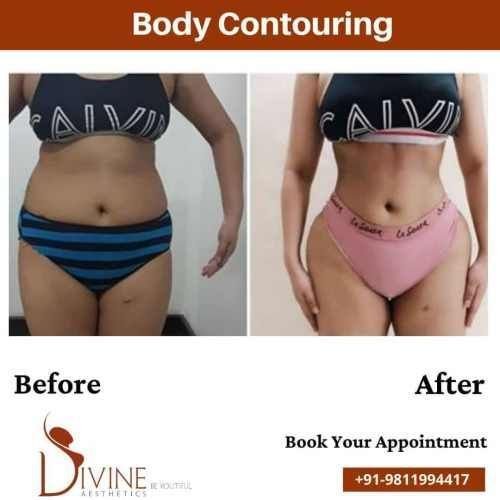 Body-Contouring-before-after-image.jpeg-nggid03381-ngg0dyn-500x500x100-00f0w010c010r110f110r010t010