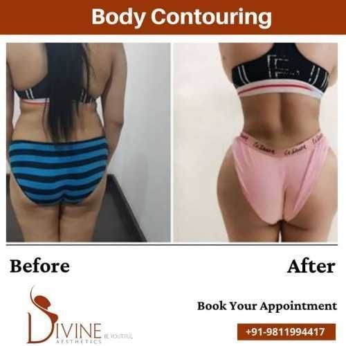 Body-Contouring-before-after-result.jpeg-nggid03380-ngg0dyn-500x500x100-00f0w010c010r110f110r010t010