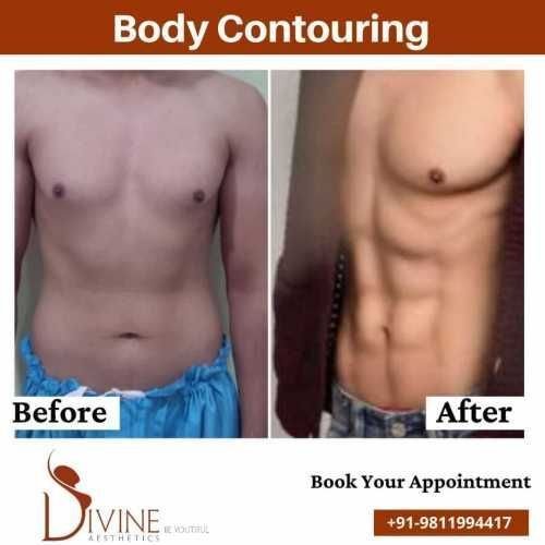 Body-Contouring-before-after-results.jpeg-nggid03379-ngg0dyn-500x500x100-00f0w010c010r110f110r010t010