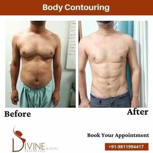 Body-Contouring-before-and-after-result.jpeg-nggid03377-ngg0dyn-500x500x100-00f0w010c010r110f110r010t010