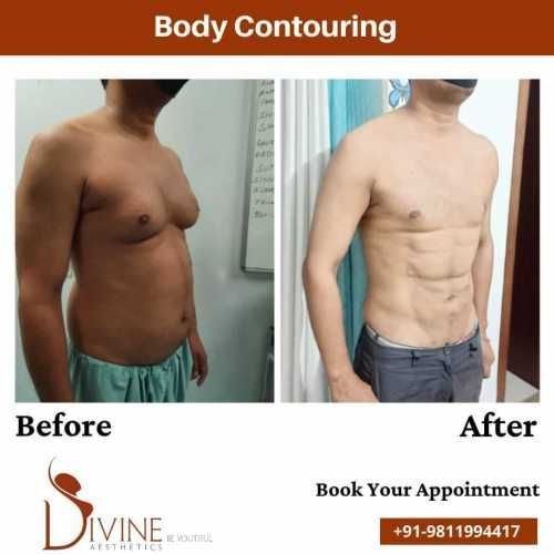 Body-Contouring-before-and-after.jpeg-nggid03376-ngg0dyn-500x500x100-00f0w010c010r110f110r010t010