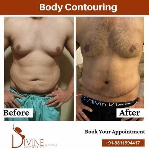 Male-Body-Contouring-before-after.jpeg-nggid03375-ngg0dyn-500x500x100-00f0w010c010r110f110r010t010
