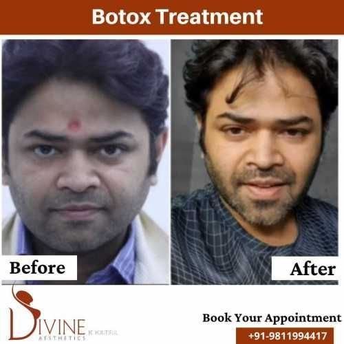 Botox-Before-After.jpeg-nggid03364-ngg0dyn-500x500x100-00f0w010c010r110f110r010t010