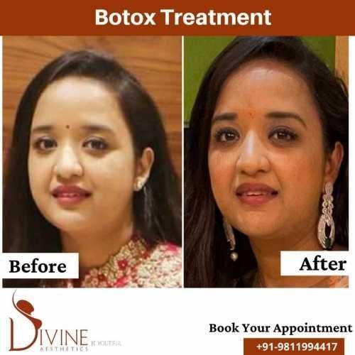 Botox-Treatment-Injection.jpeg-nggid03365-ngg0dyn-500x500x100-00f0w010c010r110f110r010t010