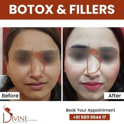 Botox-_-fillers.jpg-nggid03363-ngg0dyn-500x500x100-00f0w010c010r110f110r010t010