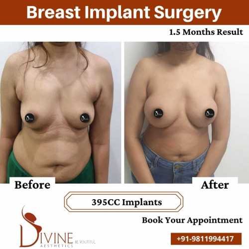 Breast-Augmentation-Before-After-1.5-Months-Results