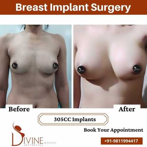 Breast-Augmentation-Before-After-305-CC