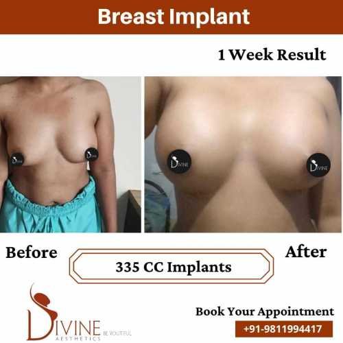 Breast-Augmentation-by-Dr-Amit-Gupta-Dec-1