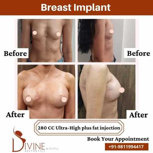 Breast-Augmentation-by-Dr-Amit-Gupta-Dec-2
