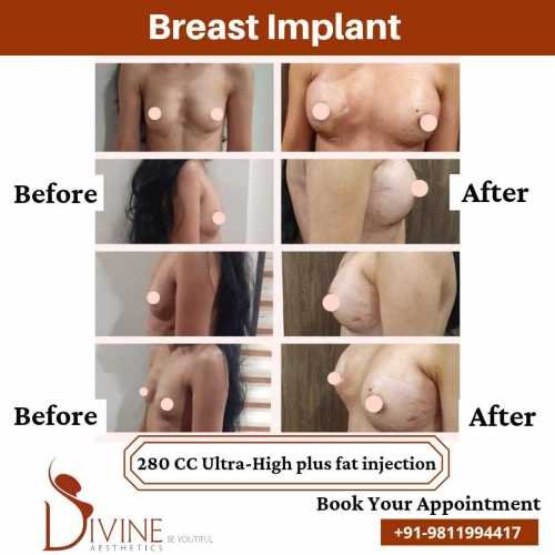 Breast-Augmentation-by-Dr-Amit-Gupta-Dec-3
