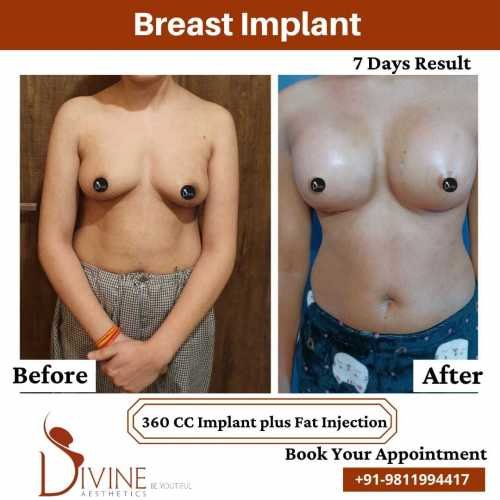 Breast-Augmentation-by-Dr-Amit-Gupta-Dec-4