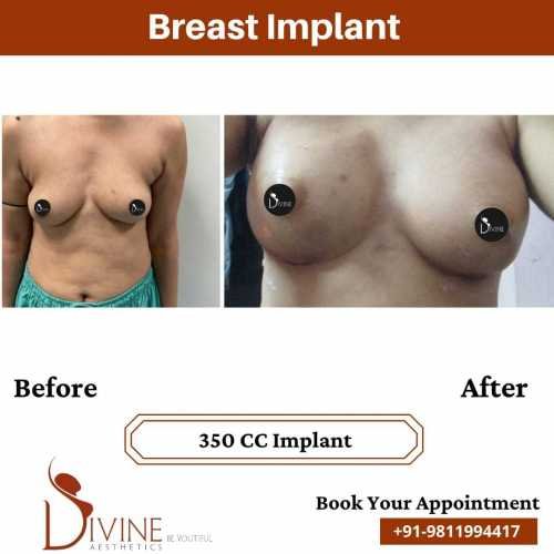 Breast-Augmentation-by-Dr-Amit-Gupta-Dec-5