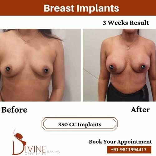 Breast-Enlargement-before-after-3-weeks-results