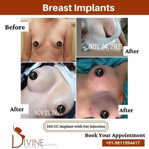 Breast-Enlargement-before-after-results