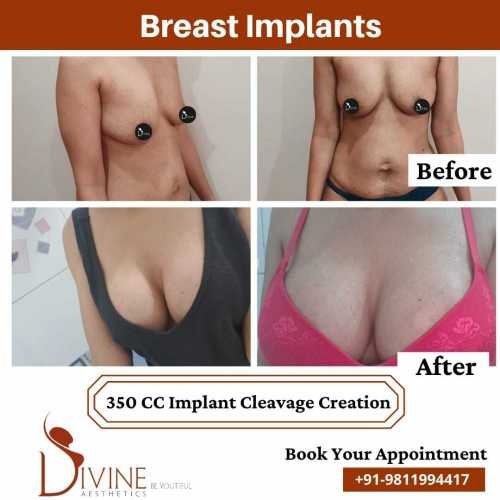 Breast-Enlargement-before-after-with-cleave-creation