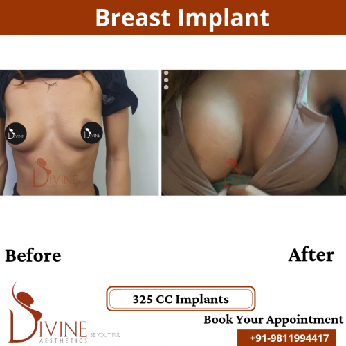 Breast-Implant-10