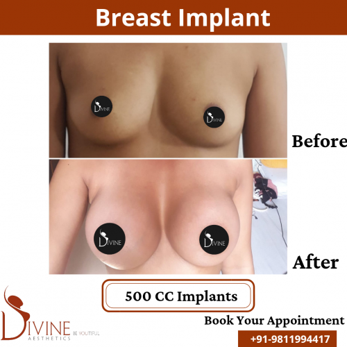 Breast-Implant-11