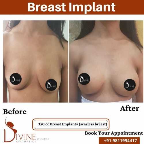 Breast-Implant-12