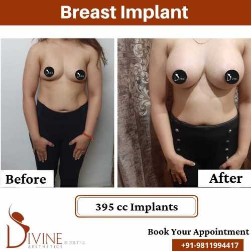 Breast-Implant-13