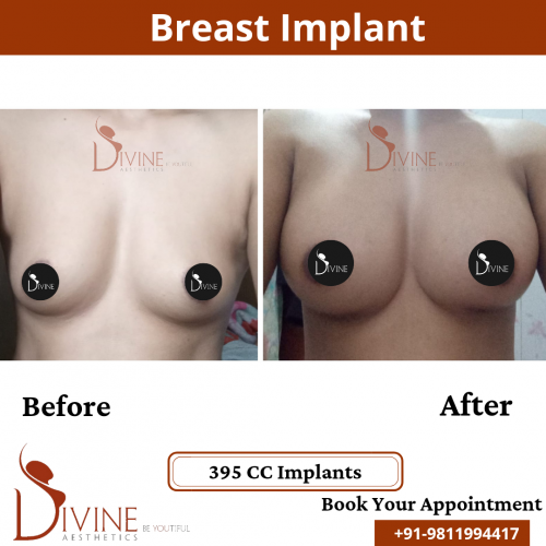 Breast-Implant-8
