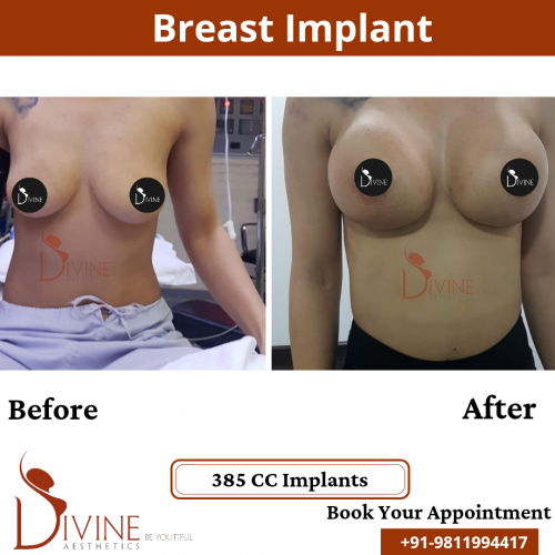 Breast-Implant-9