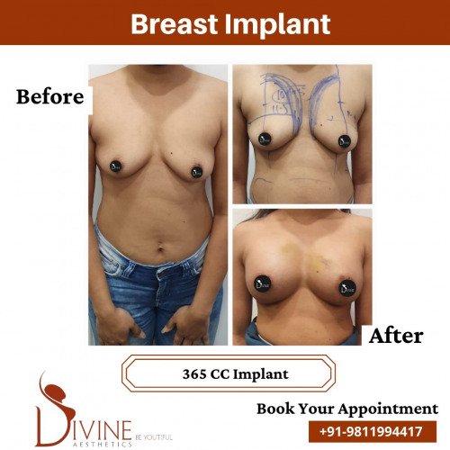 Breast-Implant-Before-After-1-Feb-22