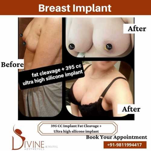 Breast-Implant-Before-After-1